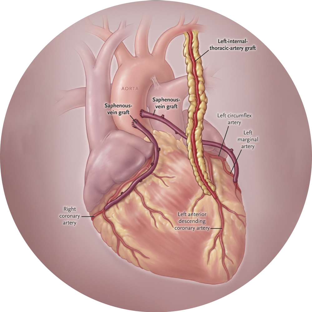 Coronary Artery Bypass